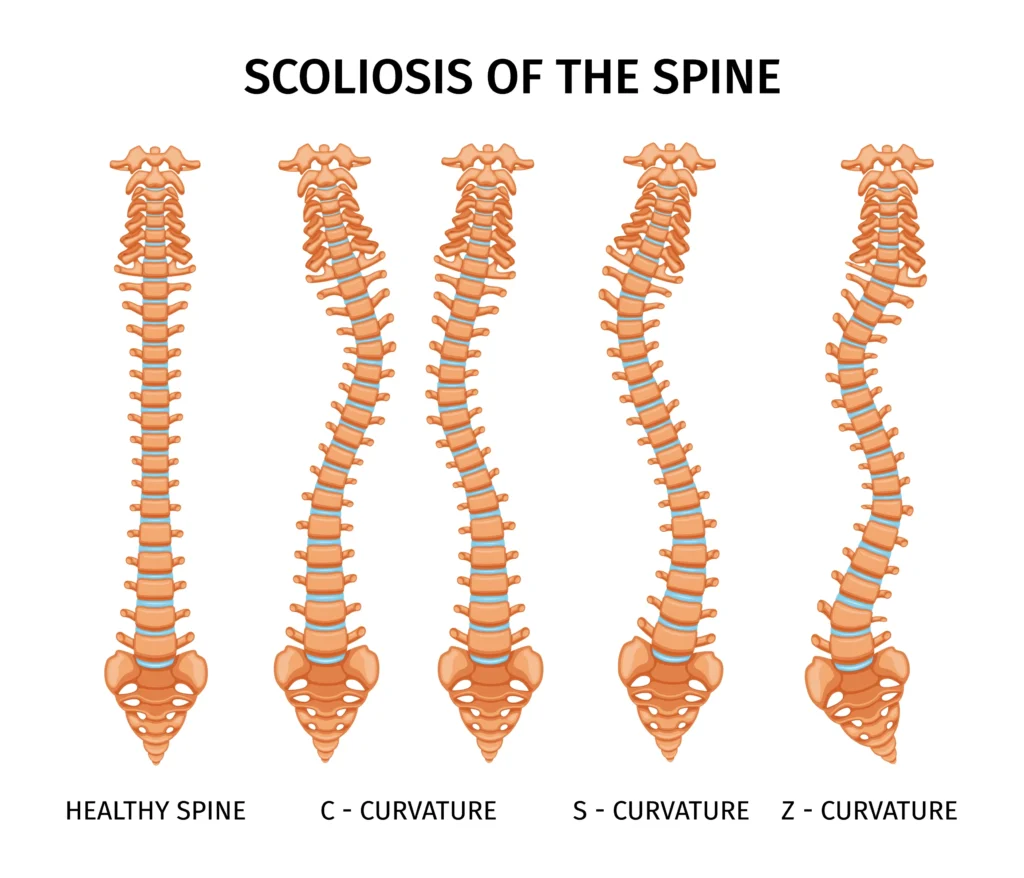 Scoliosis of the Spine