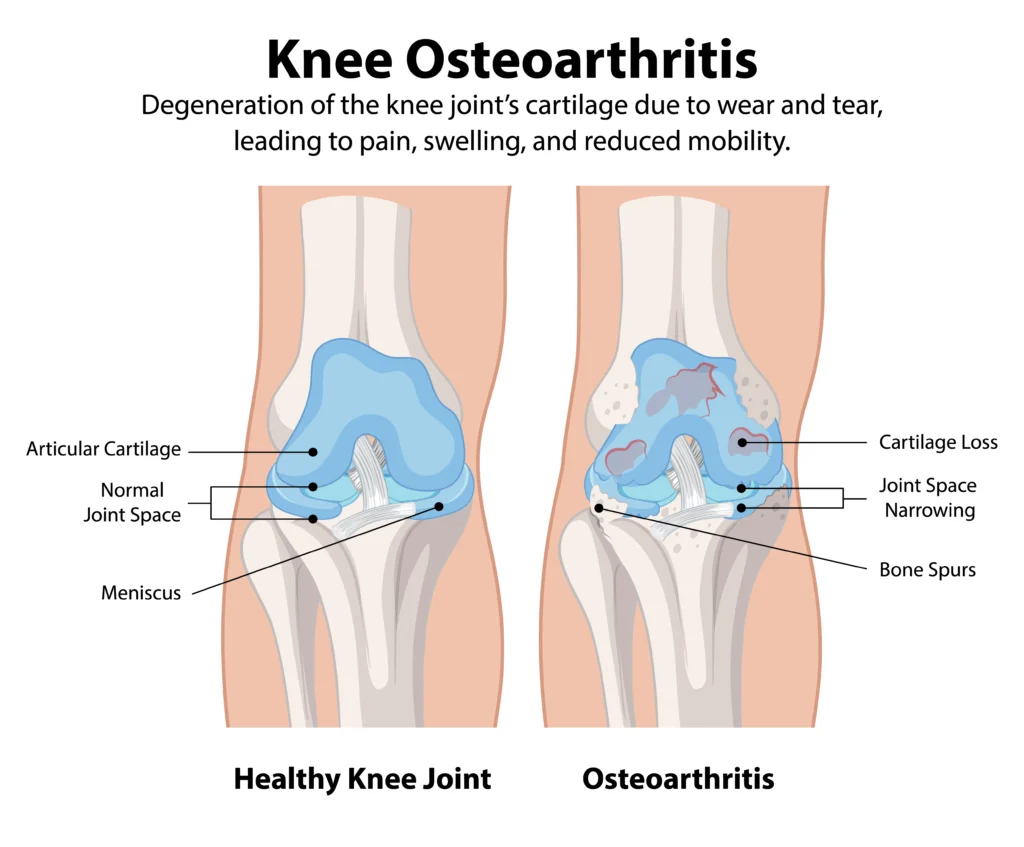 Osteoarthritis knee