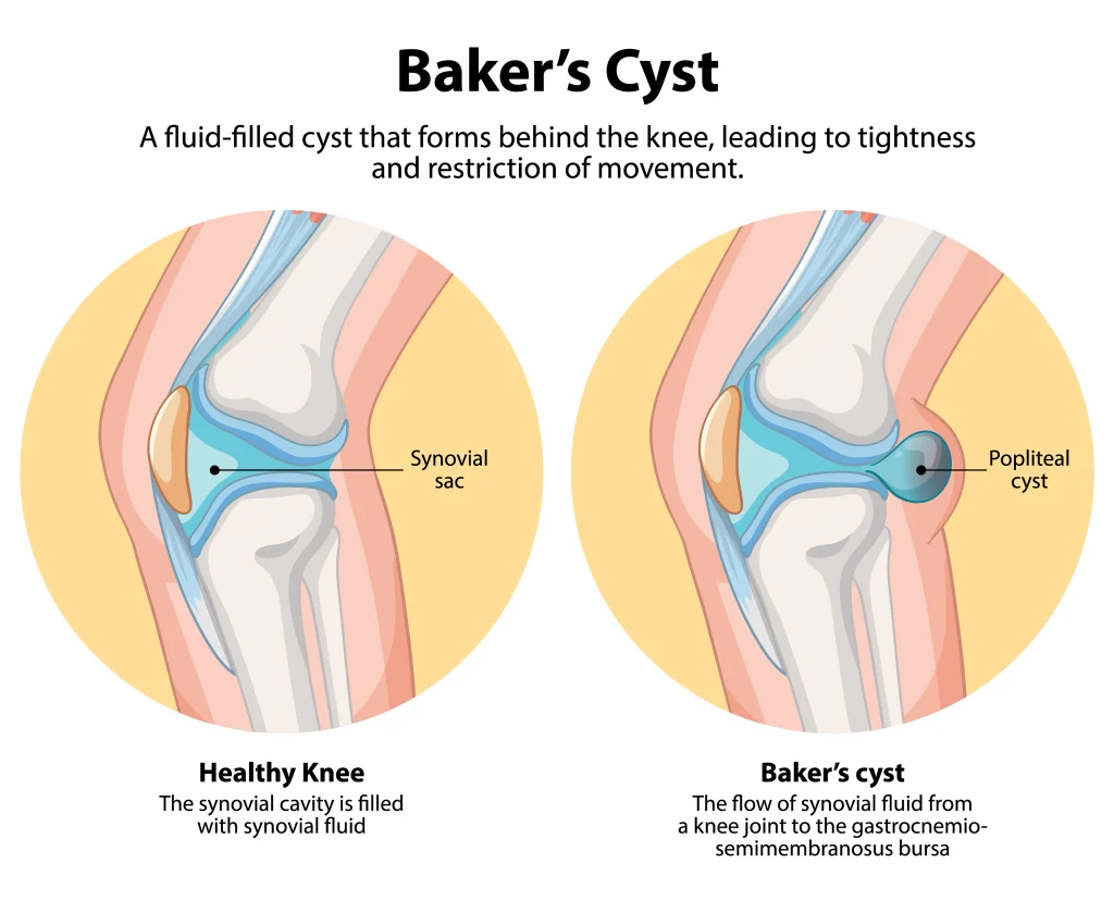Baker’s Cyst